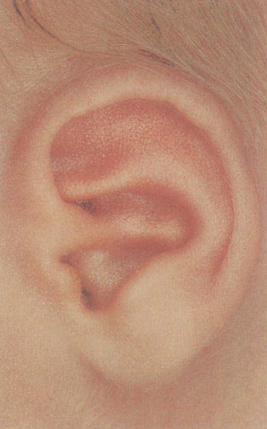 图1.2 正常新生儿耳廓